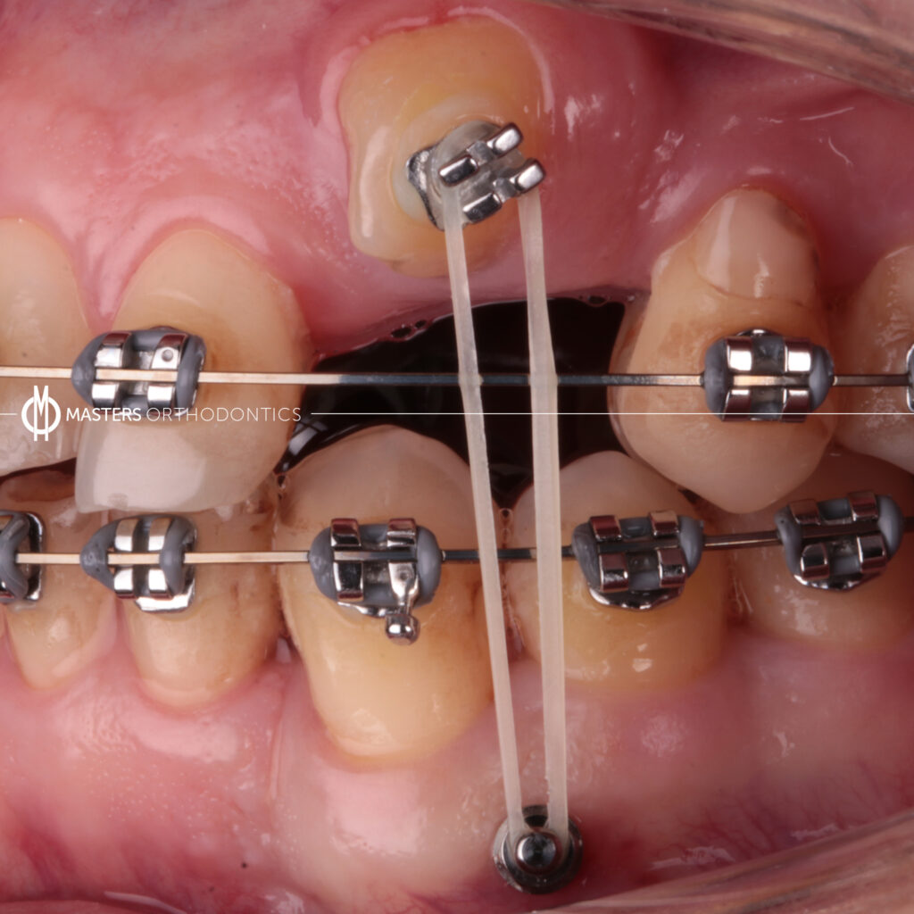 masters orthodontics case 103 masters orthodontics case 103