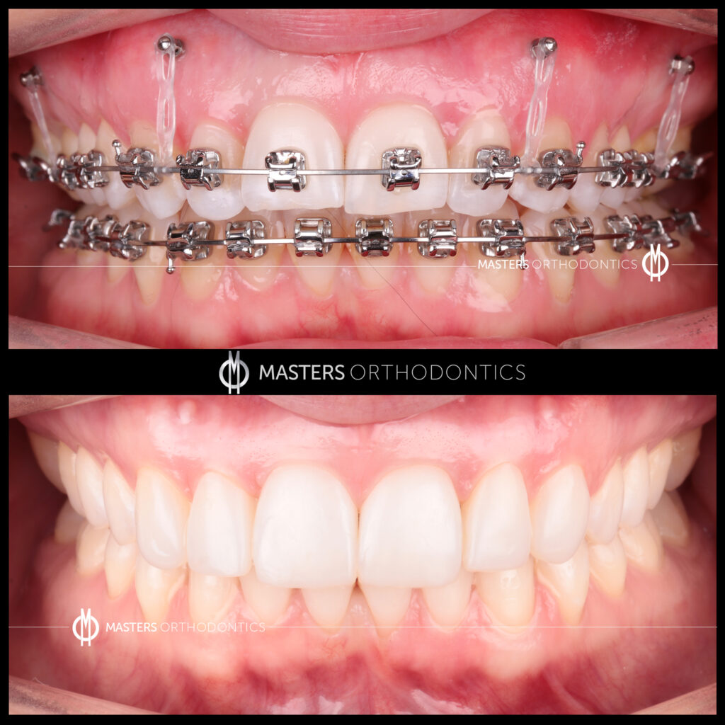 masters orthodontics case 98b masters orthodontics case 98b