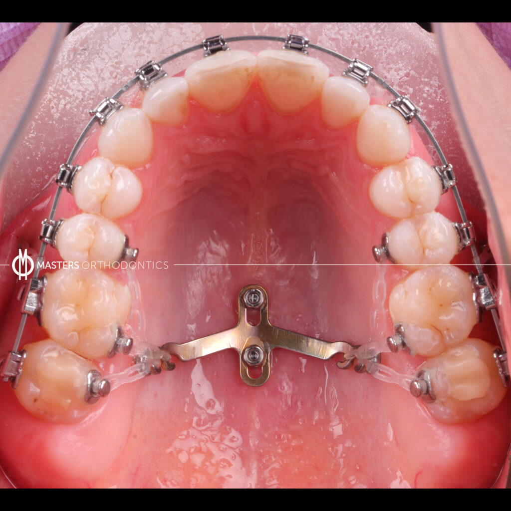 masters orthodontics case 98d masters orthodontics case 98d